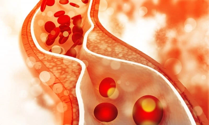 cholesterol plaque artery 800 480 85 s c1